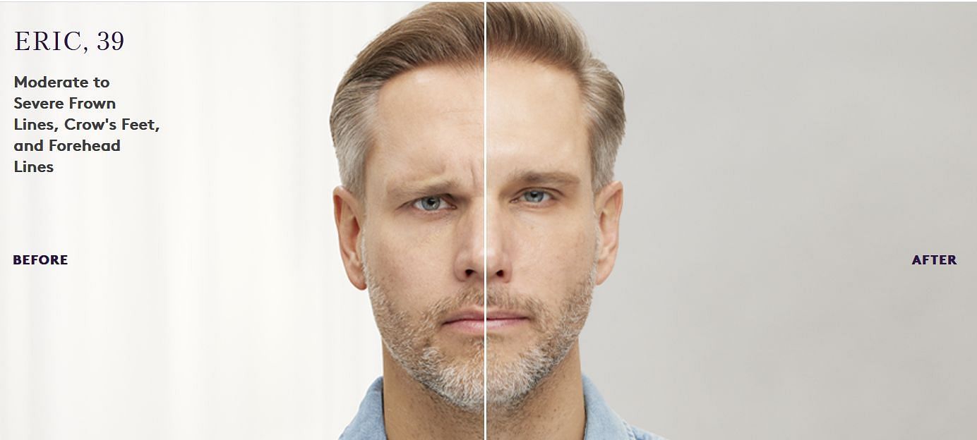 Eric got very good results after getting 'Brotox' or Botox treatment (Image via Botox Cosmetic)